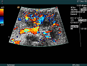 renal transplant